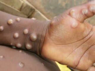 Ups !!! Afrika alami wabah 'Cacar Monyet' selama pandemi Covid-19, sayang disembunyikan di bawah 'radar'