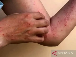 Waspada !!! Ada 88 kasus cacar monyet (Mpox) hingga 17 Agustus di RI