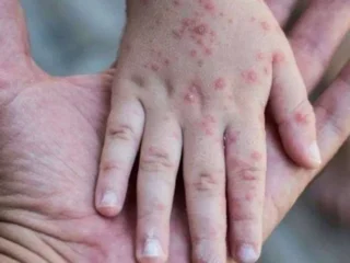 Heboh flu Singapura di sekolah, Dinkes DKI ungkap penyebarannya