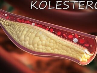 Faktor-faktor yang harus diwaspadai sebagai penyebab naiknya kolesterol